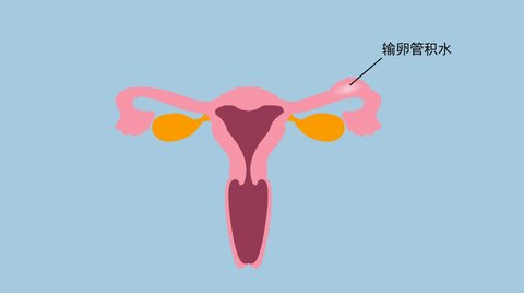 輸卵管積水能自然懷孕嗎？輸卵管積水如何懷孕？