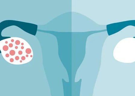 多囊對身體有什么影響？多囊對身體的影響