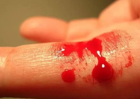 血友病做試管嬰兒會(huì)遺傳嗎？遺傳風(fēng)險(xiǎn)及預(yù)防策略