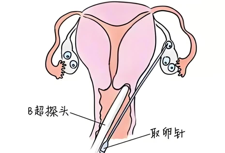 試管取卵針穿過子宮有影響嗎,試管取卵針會對子宮有傷害嗎