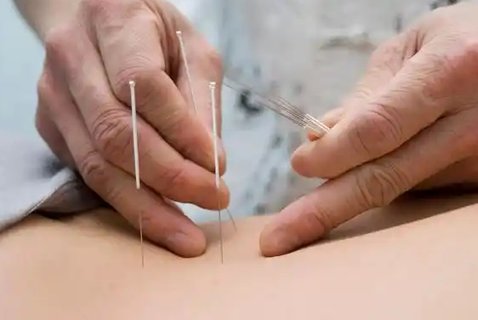 針灸助孕一個月扎幾次？每月治療頻率與效果全解析