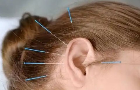 針灸助孕：古老智慧如何開啟現(xiàn)代生育之門