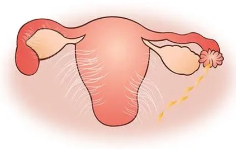 盆腔粘連影響試管嗎？盆腔粘連對(duì)試管嬰兒的影響