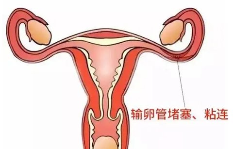 輸卵管粘連對(duì)試管有影響嗎？輸卵管粘連與試管嬰兒