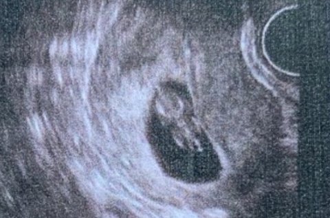 陰超可以檢查出哪些婦科疾??？陰超檢查疾病一覽